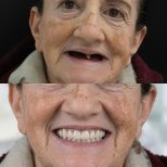 Vorher-nachher-Ergebnis All-on-6-Implantate bei Excelentis Dental Center, Lächeln wiederhergestellt
