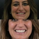 Результат до и после имплантации All-on-6 в Excelentis Dental Center, восстановление улыбки