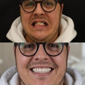 Vorher-nachher-Ergebnis All-on-6 Zahnimplantate bei Excelentis Dental Center, verbesserte Lächeln