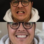 Vorher-nachher-Ergebnis All-on-6 Zahnimplantate bei Excelentis Dental Center, verbesserte Lächeln