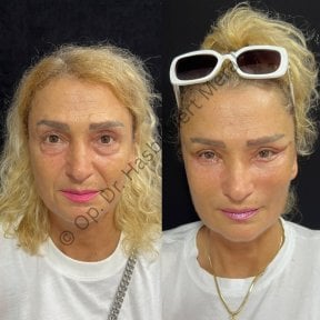 Результаты до и после подтяжки лица в клинике Dr. Hasan Duygulu – омоложение лица