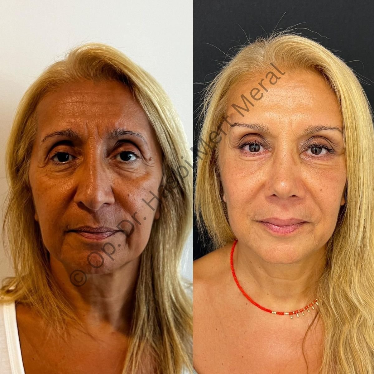 Resultados de lifting facial antes y después – rejuvenecimiento y piel más lisa
