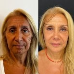 Результаты до и после подтяжки лица – заметное омоложение и гладкая кожа