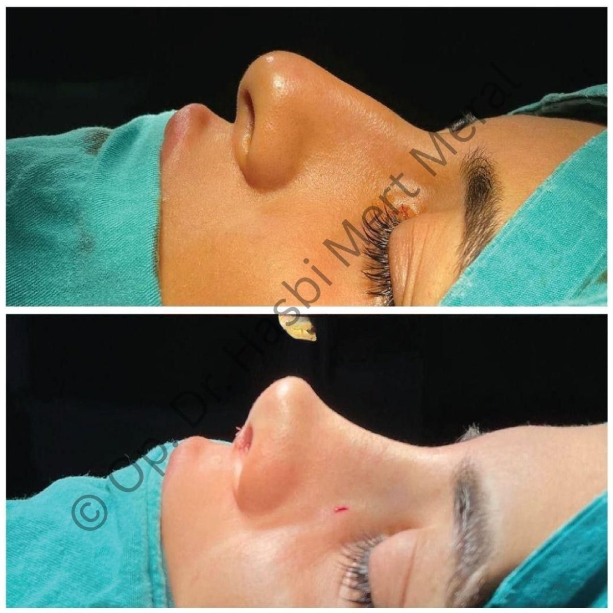 Resultados de rinoplastia antes y después, perfil nasal mejorado en la clínica