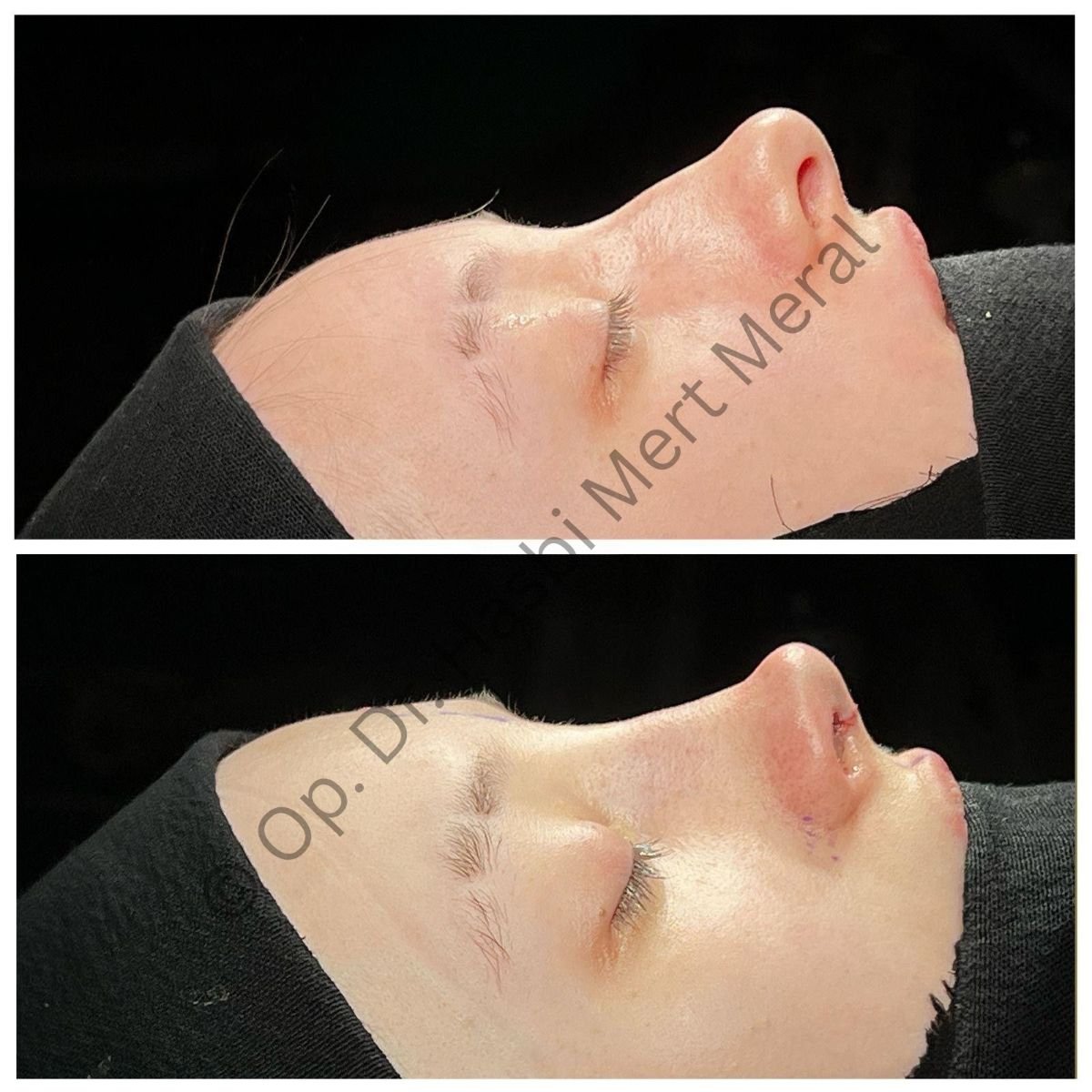 Resultados de rinoplastia antes y después por Dr. Mert Meral, cambio visible en la nariz