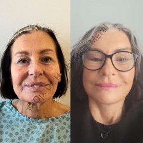 Facelift Vorher-Nachher-Ergebnisse in der Klinik, sichtbare Hautverjüngung