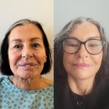 Facelift Vorher-Nachher-Ergebnisse in der Klinik, sichtbare Hautverjüngung