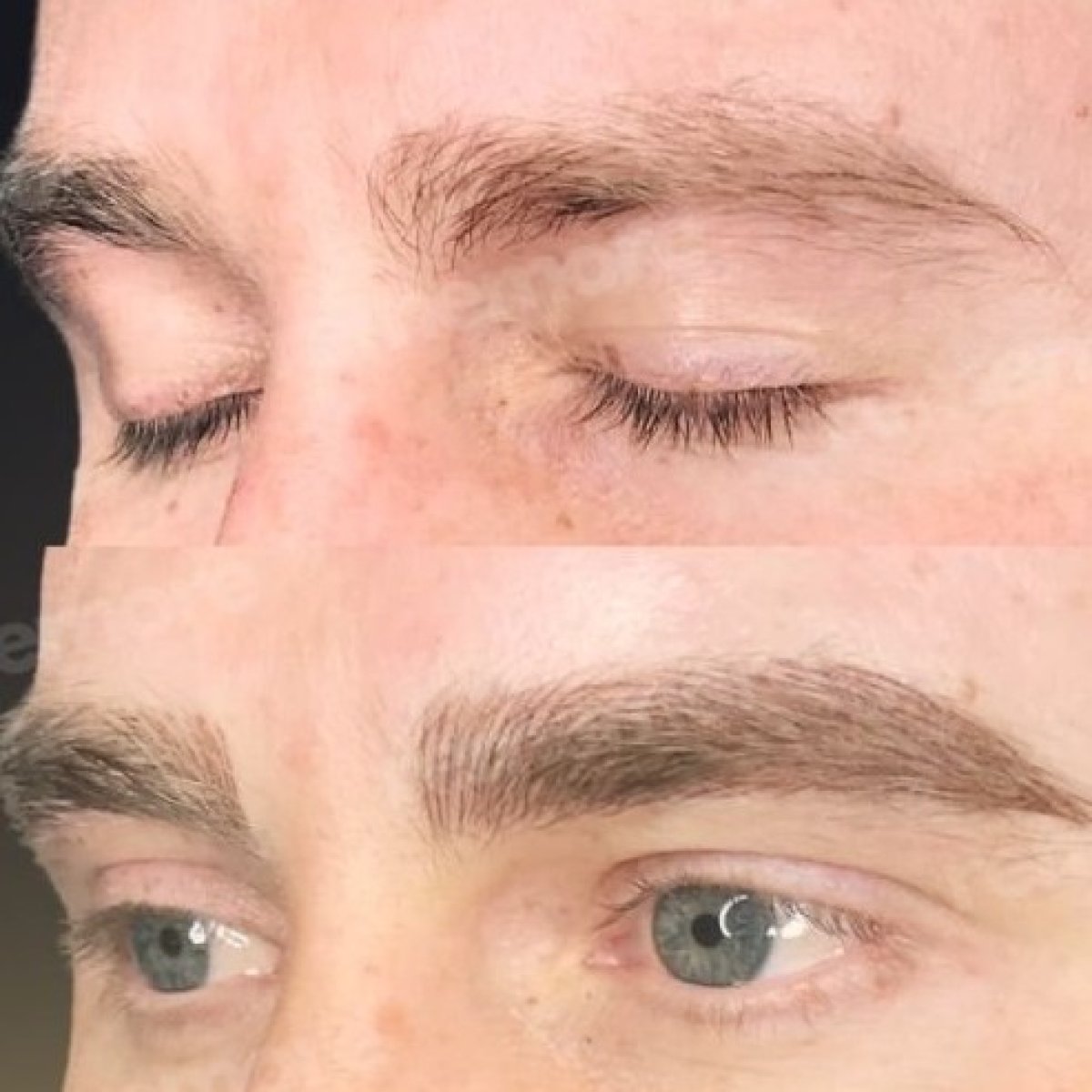 Resultados de trasplante de cejas antes y después en Memorial Bahçelievler Hospital, cejas más densas