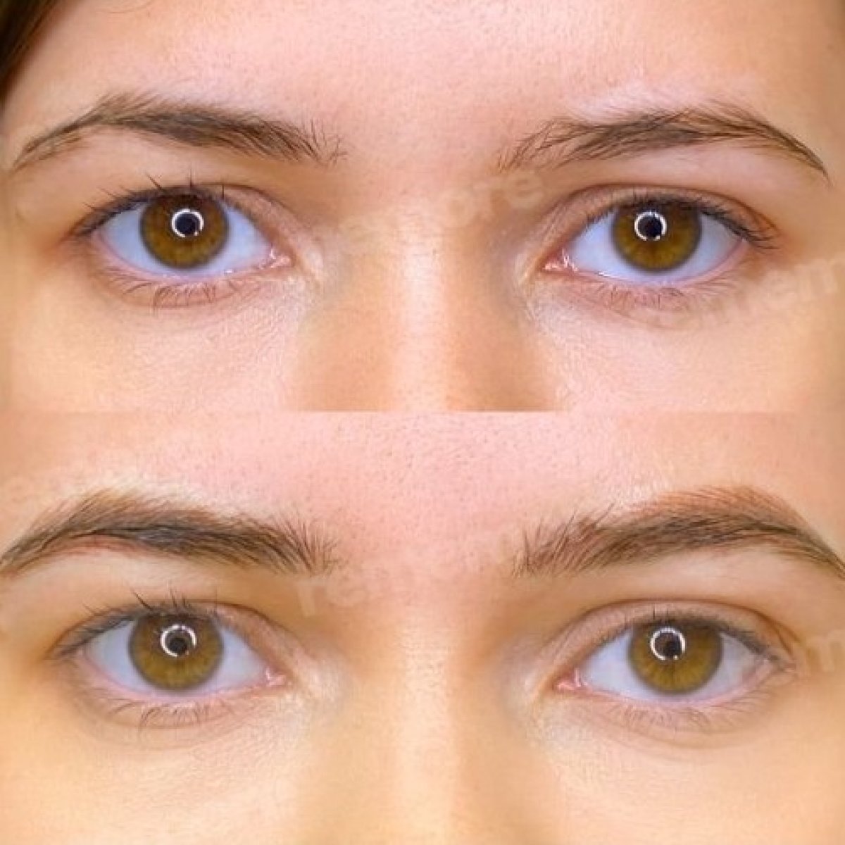 Resultados de trasplante de cejas antes y después en Memorial Bahçelievler Hospital