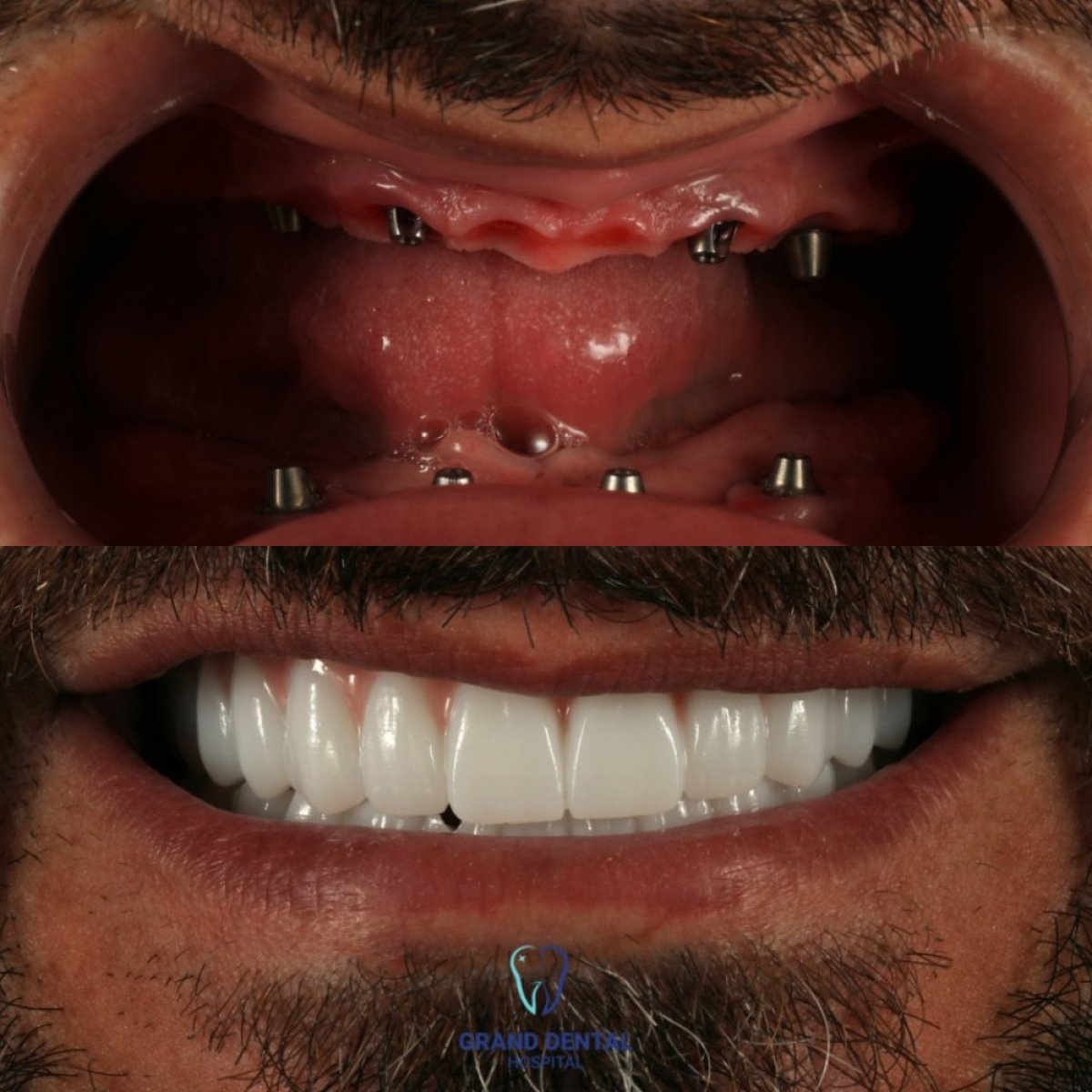 نتائج زراعة الأسنان قبل وبعد في Grand Dental Hospital & Laboratory، ابتسامة مستعادة