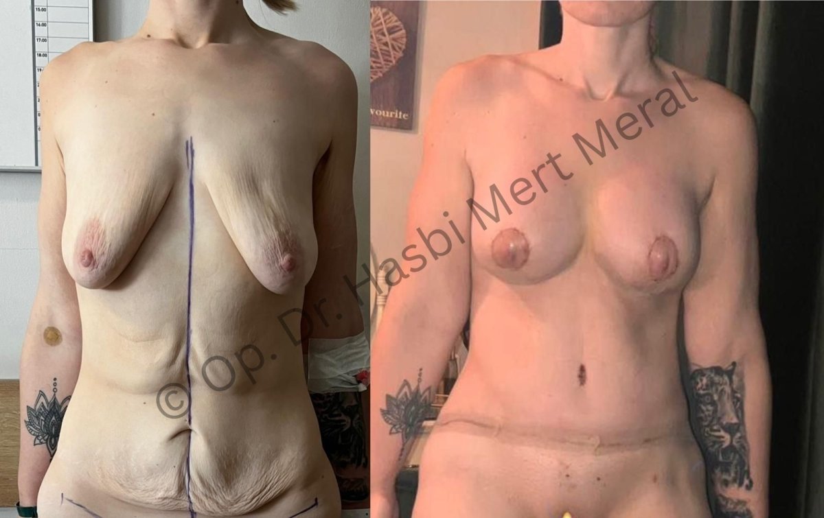 Resultados de abdominoplastia y lifting de senos antes y después por Dr. Hasbi Mert Meral