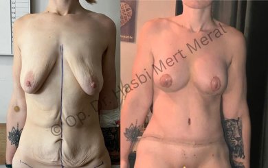 Vorher-nachher-Ergebnis Bauchdeckenstraffung und Brustlifting bei Dr. Hasbi Mert Meral