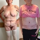 Liposuktion Vorher-Nachher-Ergebnis, sichtbare Bauchkontur-Verbesserung bei Frau