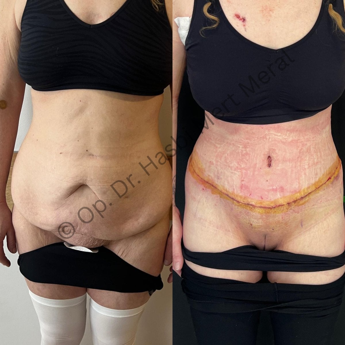 Resultados de liposucción antes y después, mejora visible del abdomen en la clínica