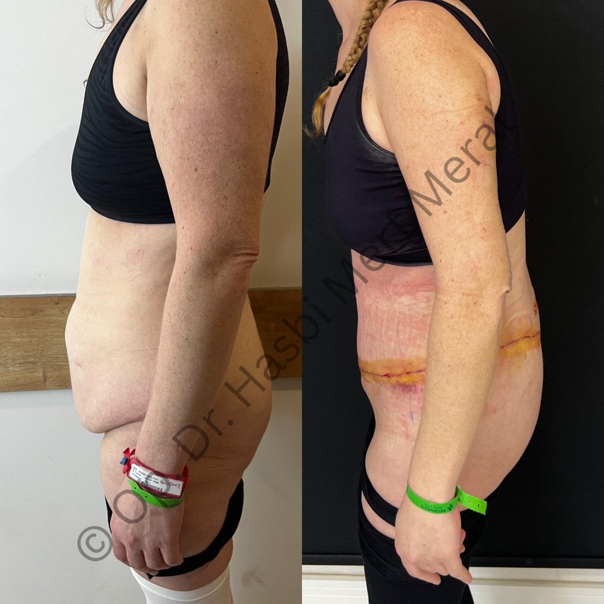 Resultados de liposucción antes y después, mejora visible del abdomen en la clínica