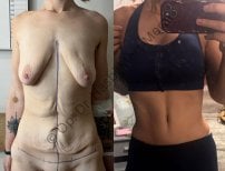 Before and after tummy tuck results by Dr. Hasbi Mert Meral – improved abdominal contour