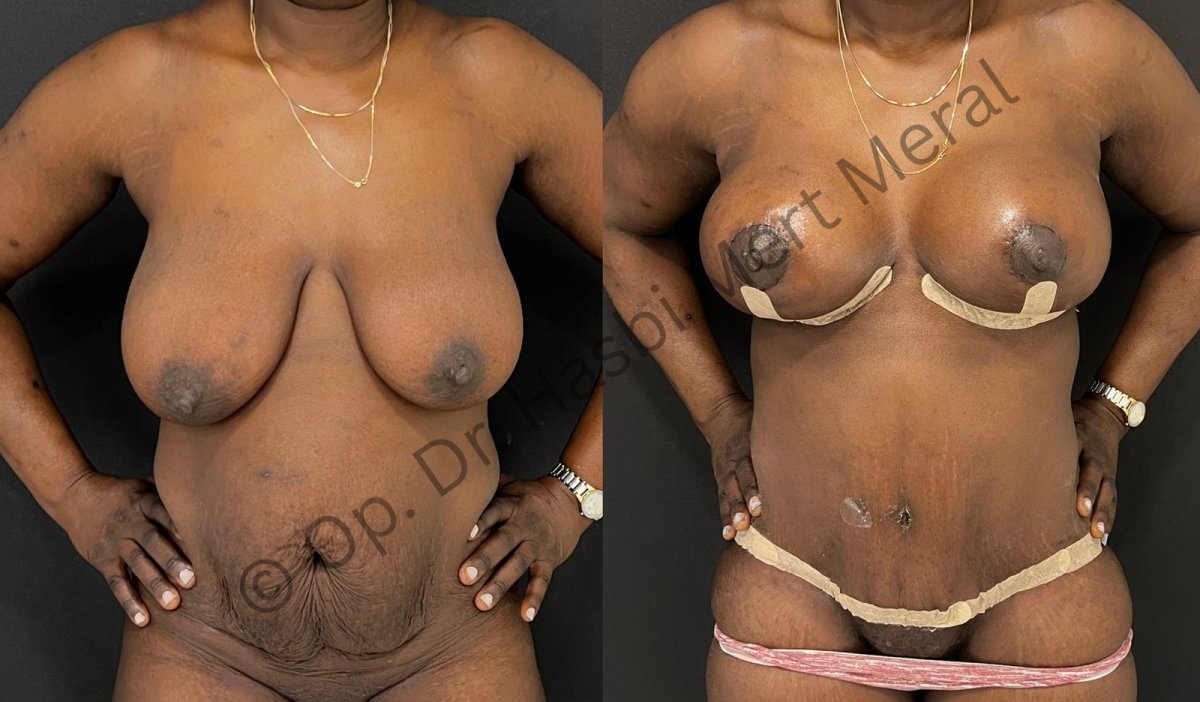 Resultados de abdominoplastia y lifting de senos antes y después, contorno mejorado