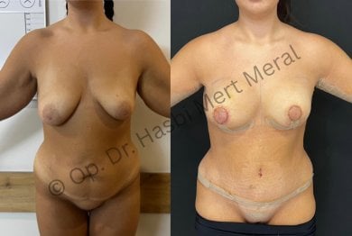 Before and after tummy tuck and breast lift results by Dr. Hasbi Mert Meral, body contouring