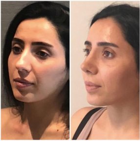 Vorher-nachher-Ergebnis der Spitzenrhinoplastik bei Adem and Havva Medical Center, verfeinerte Nase