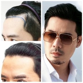 Результаты пересадки волос FUE до и после в Dr.Orn Clinic : Medical Hair, восстановленная линия волос