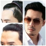 Результаты пересадки волос FUE до и после в Dr.Orn Clinic : Medical Hair, восстановленная линия волос