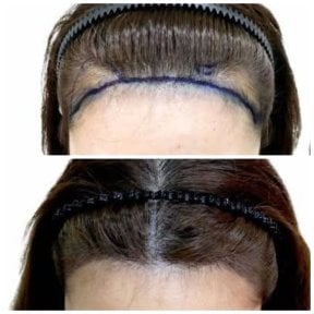 Результат пересадки волос FUE до и после в Dr.Orn Clinic : Medical Hair, улучшенная линия роста