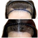 Результат пересадки волос FUE до и после в Dr.Orn Clinic : Medical Hair, улучшенная линия роста