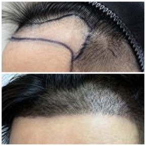 Before and after hair transplant results at Dr.Orn Clinic : Medical Hair, improved hairline
