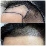 Before and after hair transplant results at Dr.Orn Clinic : Medical Hair, improved hairline