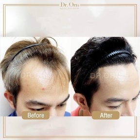 Before and after hair transplant results at Dr.Orn Clinic : Medical Hair, restored hairline