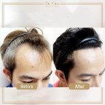 Before and after hair transplant results at Dr.Orn Clinic : Medical Hair, restored hairline