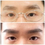 Результати трансплантації брів до і після в Dr.Orn Clinic : Medical Hair, густі брови