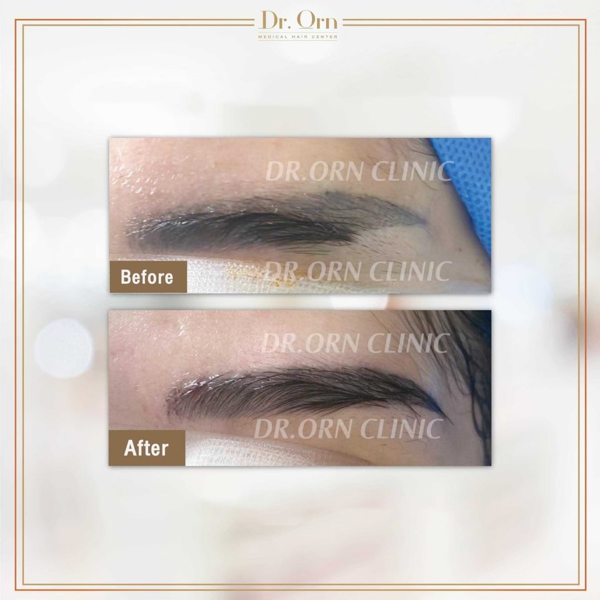 نتيجة زراعة الحواجب قبل وبعد في Dr.Orn Clinic : Medical Hair، حواجب أكثر كثافة