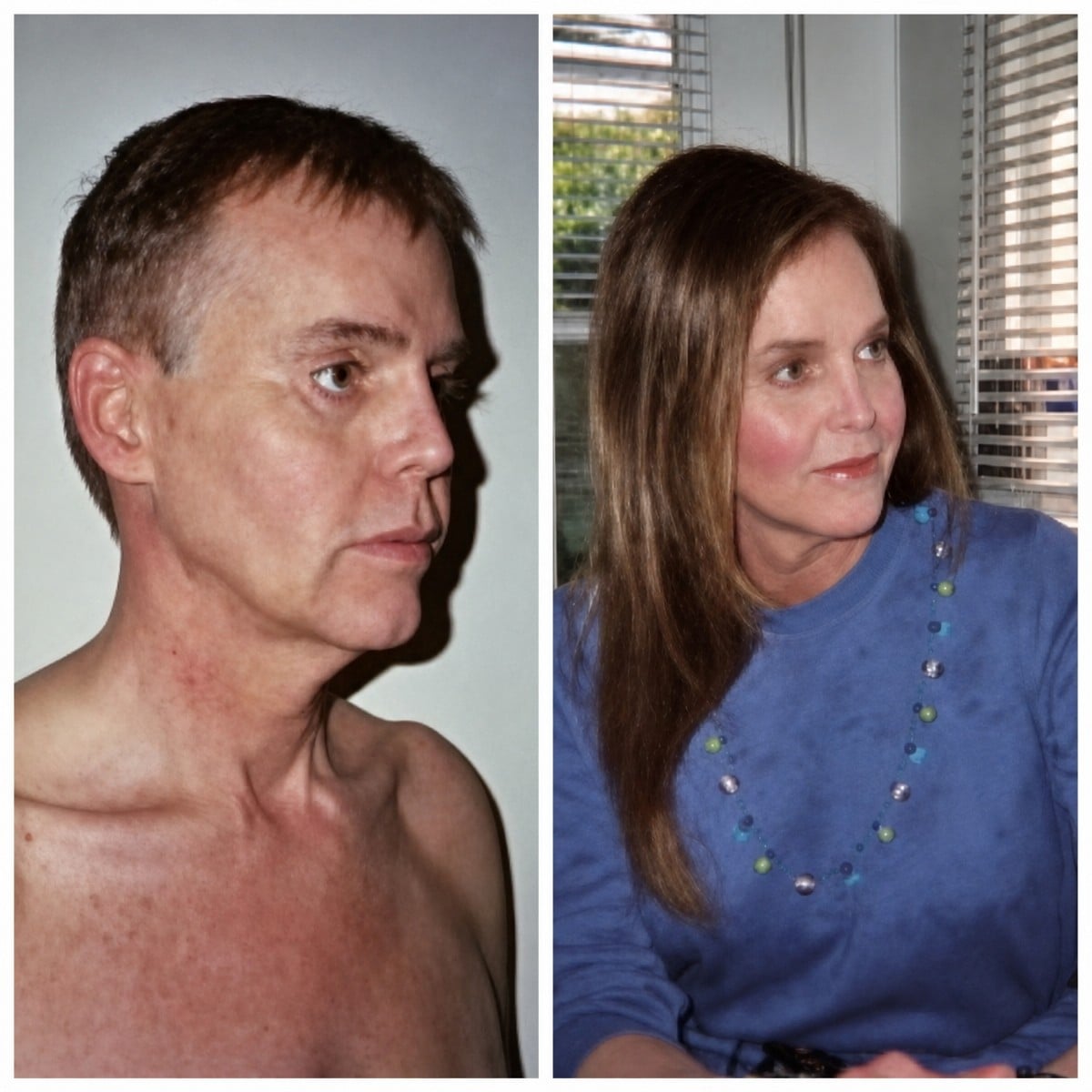 Resultados de cirugía de feminización facial antes y después en Bangkok Plastic Surgery, rasgos suaves