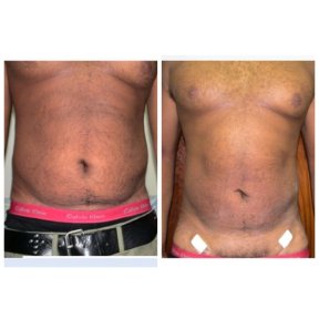 Результаты липосакции до и после в Bangkok Plastic Surgery, видимое моделирование живота