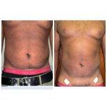 Результаты липосакции до и после в Bangkok Plastic Surgery, видимое моделирование живота