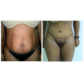Vorher-nachher-Ergebnis Bauchdeckenstraffung bei Bangkok Plastic Surgery, verbesserte Kontur