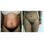 Vorher-nachher-Ergebnis Bauchdeckenstraffung bei Bangkok Plastic Surgery, verbesserte Kontur
