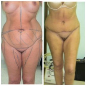 Vorher-nachher-Ergebnis Bauchdeckenstraffung bei Bangkok Plastic Surgery, verbesserte Kontur