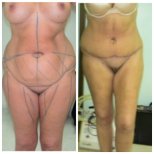 Vorher-nachher-Ergebnis Bauchdeckenstraffung bei Bangkok Plastic Surgery, verbesserte Kontur