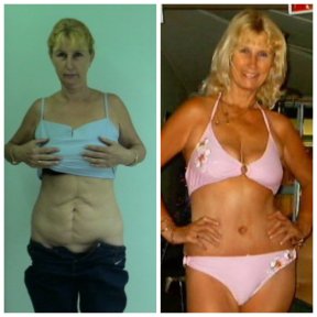Vorher-nachher-Ergebnis Bauchdeckenstraffung bei Bangkok Plastic Surgery – flacher Bauch