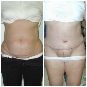 Vorher-nachher-Ergebnis Bauchdeckenstraffung bei Bangkok Plastic Surgery, verbesserte Kontur