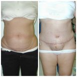 Vorher-nachher-Ergebnis Bauchdeckenstraffung bei Bangkok Plastic Surgery, verbesserte Kontur