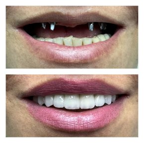 Before and after dental implant results at Nifa Dent International – restored natural smile
