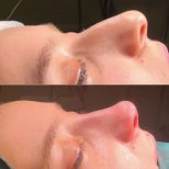 Vorher-nachher-Ergebnis der Spitzenrhinoplastik bei Adem and Havva Medical Center, verfeinerte Nase