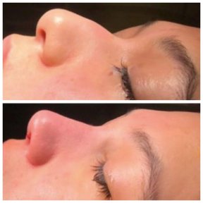 Vorher-nachher-Ergebnis der Spitzenrhinoplastik bei Adem and Havva Medical Center, verfeinerte Nase