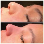 Vorher-nachher-Ergebnis der Spitzenrhinoplastik bei Adem and Havva Medical Center, verfeinerte Nase