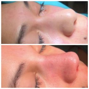 Vorher-nachher-Ergebnis der Nasenspitzenkorrektur bei Adem and Havva Medical Center, verfeinerte Nase