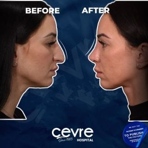 Vorher-nachher-Rhinoplastik-Ergebnisse bei Adem and Havva Medical Center, verbesserte Nasenform