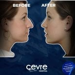 Vorher-nachher-Ergebnisse der Nasenkorrektur im Cevre Hospital, sichtbare Nasenverbesserung